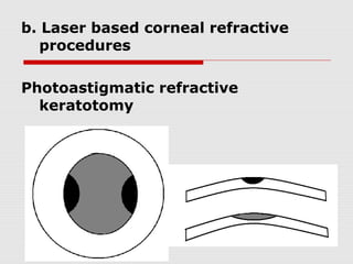 b. Laser based corneal refractive
procedures
Photoastigmatic refractive
keratotomy

 