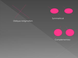 Oblique Astigmatism
Symmetrical
Complementary
 