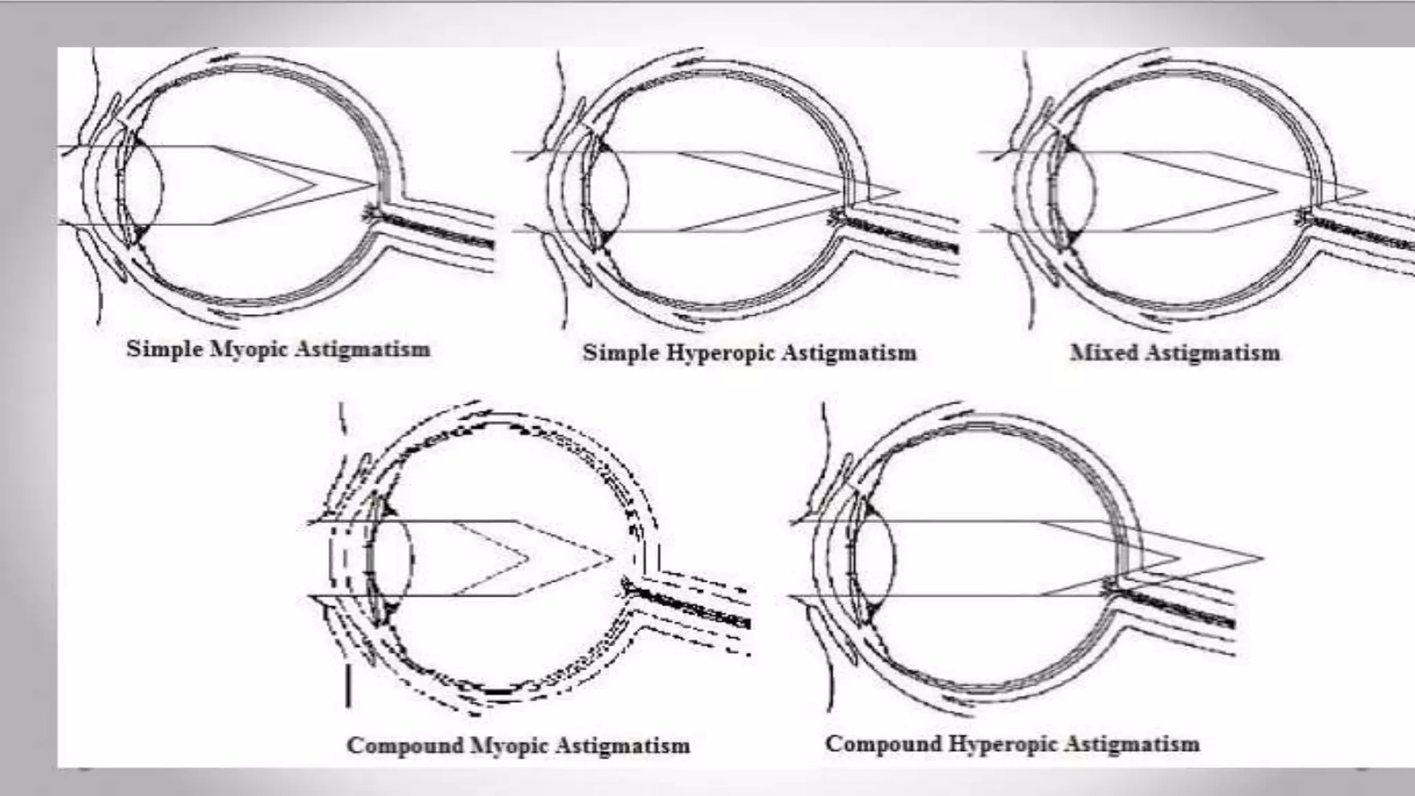 Astigmatism | PPTX