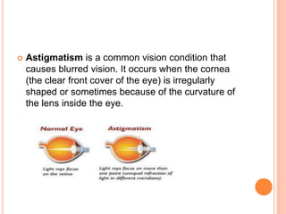  Astigmatism is a common vision condition that
causes blurred vision. It occurs when the cornea
(the clear front cover of the eye) is irregularly
shaped or sometimes because of the curvature of
the lens inside the eye.
 