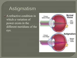 A refractive condition in
which a variation of
power exists in the
different meridians of the
eye.
 