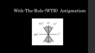 With-The-Rule (WTR) Astigmatism
 