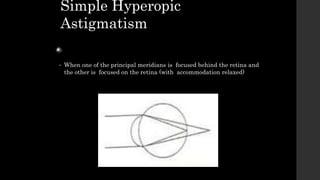 Simple Hyperopic
Astigmatism
• When one of the principal meridians is focused behind the retina and
the other is focused on the retina (with accommodation relaxed)
 
