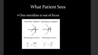 What Patient Sees
One meridian is out of focus
 