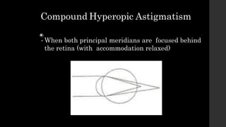 ASTIGMATISM.pptx
