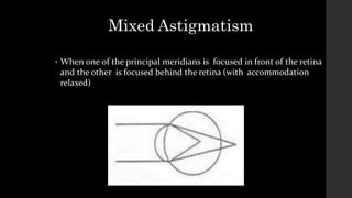 Mixed Astigmatism
• When one of the principal meridians is focused in front of the retina
and the other is focused behind the retina (with accommodation
relaxed)
 