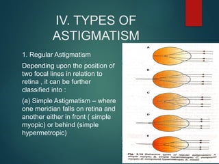 IV. TYPES OF
ASTIGMATISM
1. Regular Astigmatism
Depending upon the position of
two focal lines in relation to
retina , it can be further
classified into :
(a) Simple Astigmatism – where
one meridian falls on retina and
another either in front ( simple
myopic) or behind (simple
hypermetropic)
 