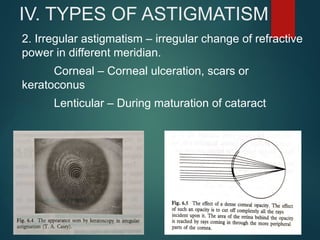 IV. TYPES OF ASTIGMATISM
2. Irregular astigmatism – irregular change of refractive
power in different meridian.
Corneal – Corneal ulceration, scars or
keratoconus
Lenticular – During maturation of cataract
 
