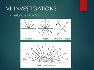 VI. INVESTIGATIONS
 Astigmatism Fan Test
 