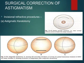 SURGICAL CORRECTION OF
ASTIGMATISM
 Incisional refractive procedures –
(a) Astigmatic Keratotomy
 