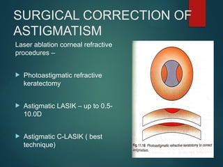 SURGICAL CORRECTION OF
ASTIGMATISM
Laser ablation corneal refractive
procedures –
 Photoastigmatic refractive
keratectomy
 Astigmatic LASIK – up to 0.5-
10.0D
 Astigmatic C-LASIK ( best
technique)
 