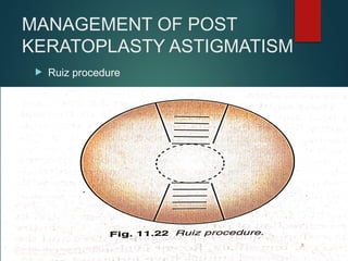 MANAGEMENT OF POST
KERATOPLASTY ASTIGMATISM
 Ruiz procedure
 