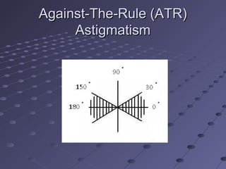 Against-The-Rule (ATR)Against-The-Rule (ATR)
AstigmatismAstigmatism
 
