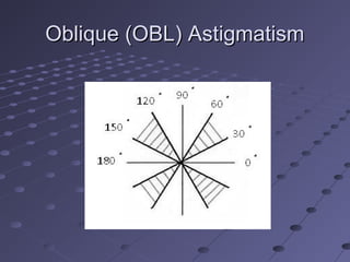 Oblique (OBL) AstigmatismOblique (OBL) Astigmatism
 