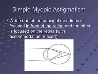 Simple Myopic AstigmatismSimple Myopic Astigmatism
When one of the principal meridians isWhen one of the principal meridians is
focusedfocused in front of the retinain front of the retina and the otherand the other
is focusedis focused on the retinaon the retina (with(with
accommodation relaxed)accommodation relaxed)
 