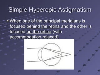 Simple Hyperopic AstigmatismSimple Hyperopic Astigmatism
When one of the principal meridians isWhen one of the principal meridians is
focusedfocused behind the retinabehind the retina and the other isand the other is
focusedfocused on the retinaon the retina (with(with
accommodation relaxed)accommodation relaxed)
 