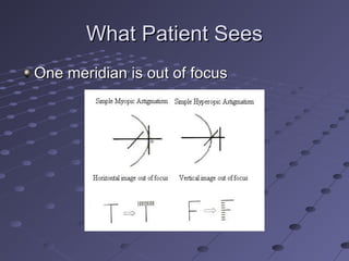 What Patient SeesWhat Patient Sees
One meridian is out of focusOne meridian is out of focus
 