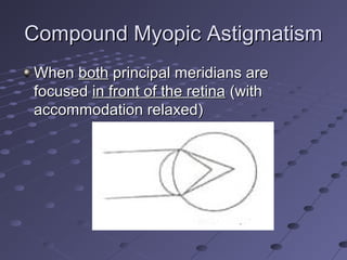 Compound Myopic AstigmatismCompound Myopic Astigmatism
WhenWhen bothboth principal meridians areprincipal meridians are
focusedfocused in front of the retinain front of the retina (with(with
accommodation relaxed)accommodation relaxed)
 