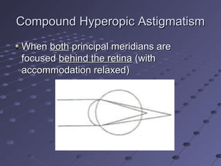 Compound Hyperopic AstigmatismCompound Hyperopic Astigmatism
WhenWhen bothboth principal meridians areprincipal meridians are
focusedfocused behind the retinabehind the retina (with(with
accommodation relaxed)accommodation relaxed)
 