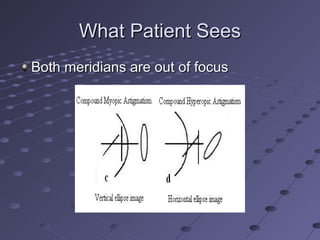 What Patient SeesWhat Patient Sees
Both meridians are out of focusBoth meridians are out of focus
 