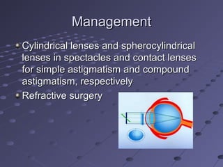 ManagementManagement
Cylindrical lenses and spherocylindricalCylindrical lenses and spherocylindrical
lenses in spectacles and contact lenseslenses in spectacles and contact lenses
for simple astigmatism and compoundfor simple astigmatism and compound
astigmatism, respectivelyastigmatism, respectively
Refractive surgeryRefractive surgery
 