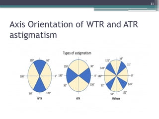11
Axis Orientation of WTR and ATR
astigmatism
 