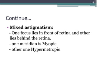 15
Continue…
• Mixed astigmatism:
- One focus lies in front of retina and other
lies behind the retina.
- one meridian is Myopic
- other one Hypermetropic
 