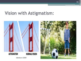 19
Vision with Astigmatism:
 