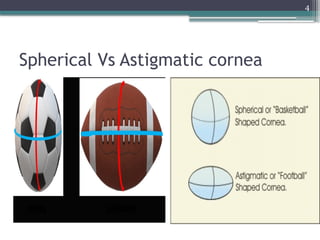 4
Spherical Vs Astigmatic cornea
 
