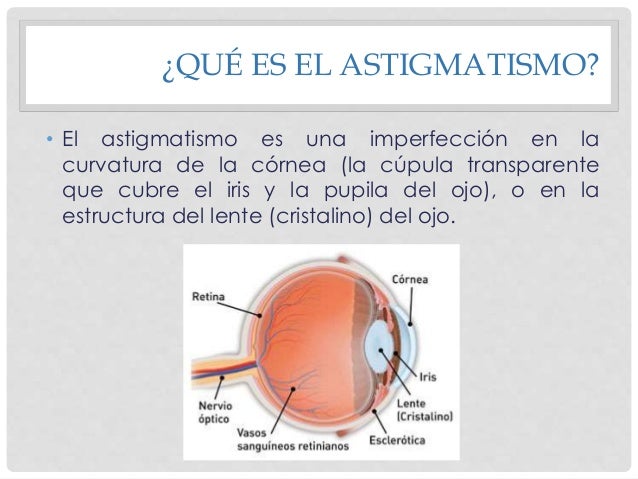 astigmatismo astigmatismo