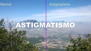 Astigmatismo | PPTX