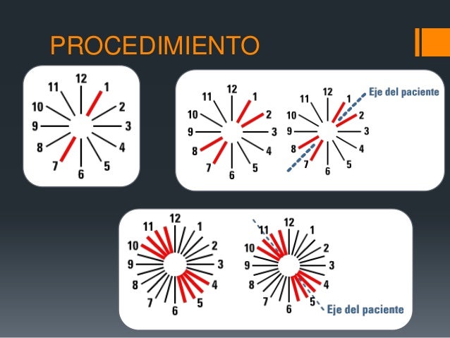 Clock Dial Test For Astigmatism