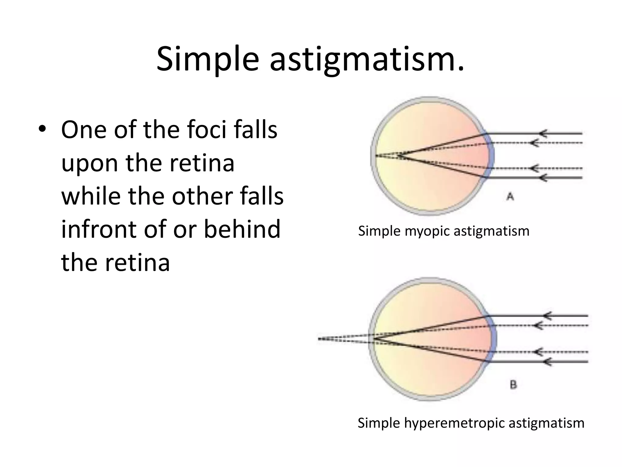 Simple astigmatism.
• One of the foci falls
upon the retina
while the other falls
infront of or behind
the retina
Simple myopic astigmatism
Simple hyperemetropic astigmatism
 