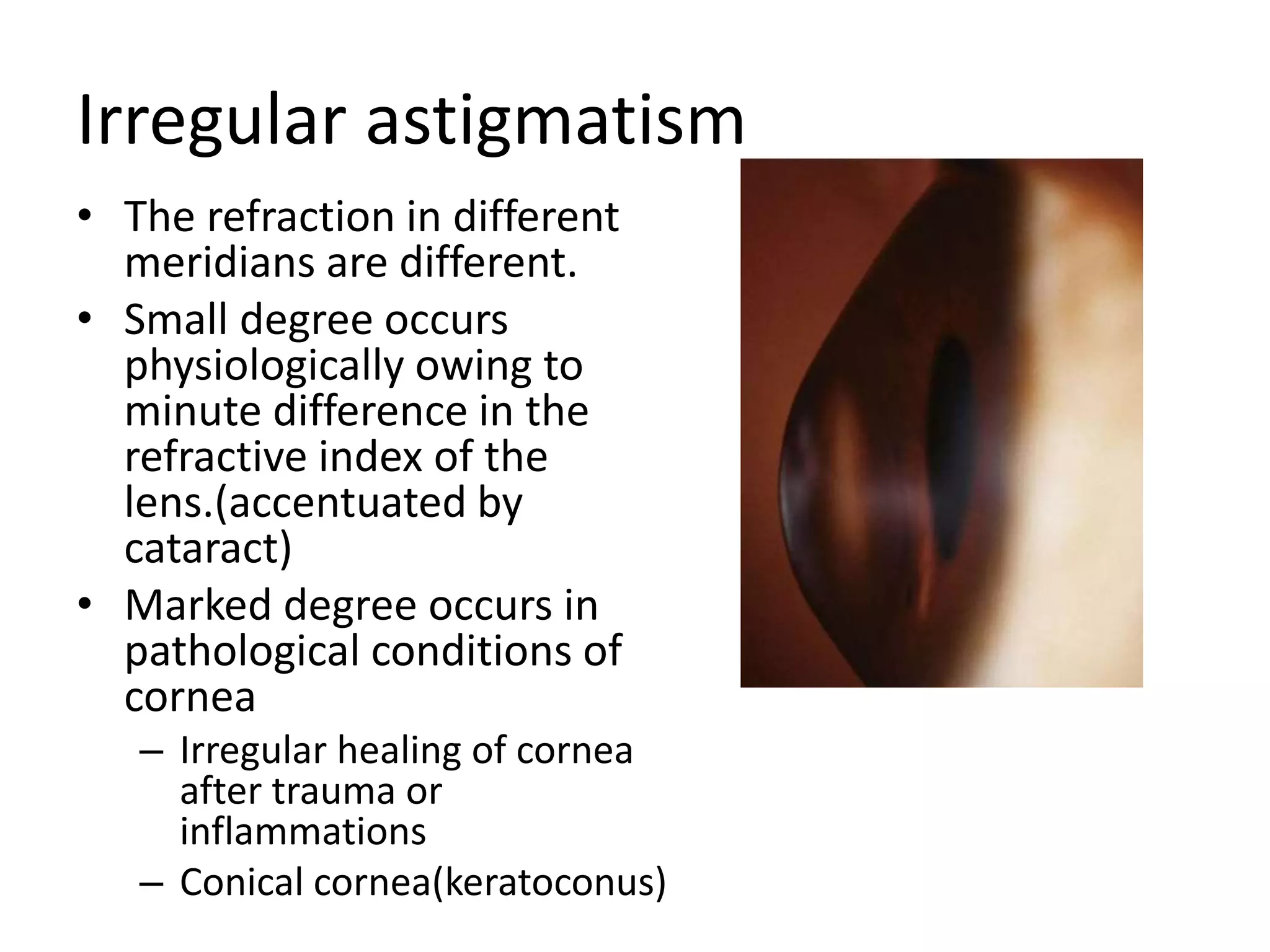Irregular astigmatism
• The refraction in different
meridians are different.
• Small degree occurs
physiologically owing to
minute difference in the
refractive index of the
lens.(accentuated by
cataract)
• Marked degree occurs in
pathological conditions of
cornea
– Irregular healing of cornea
after trauma or
inflammations
– Conical cornea(keratoconus)
 