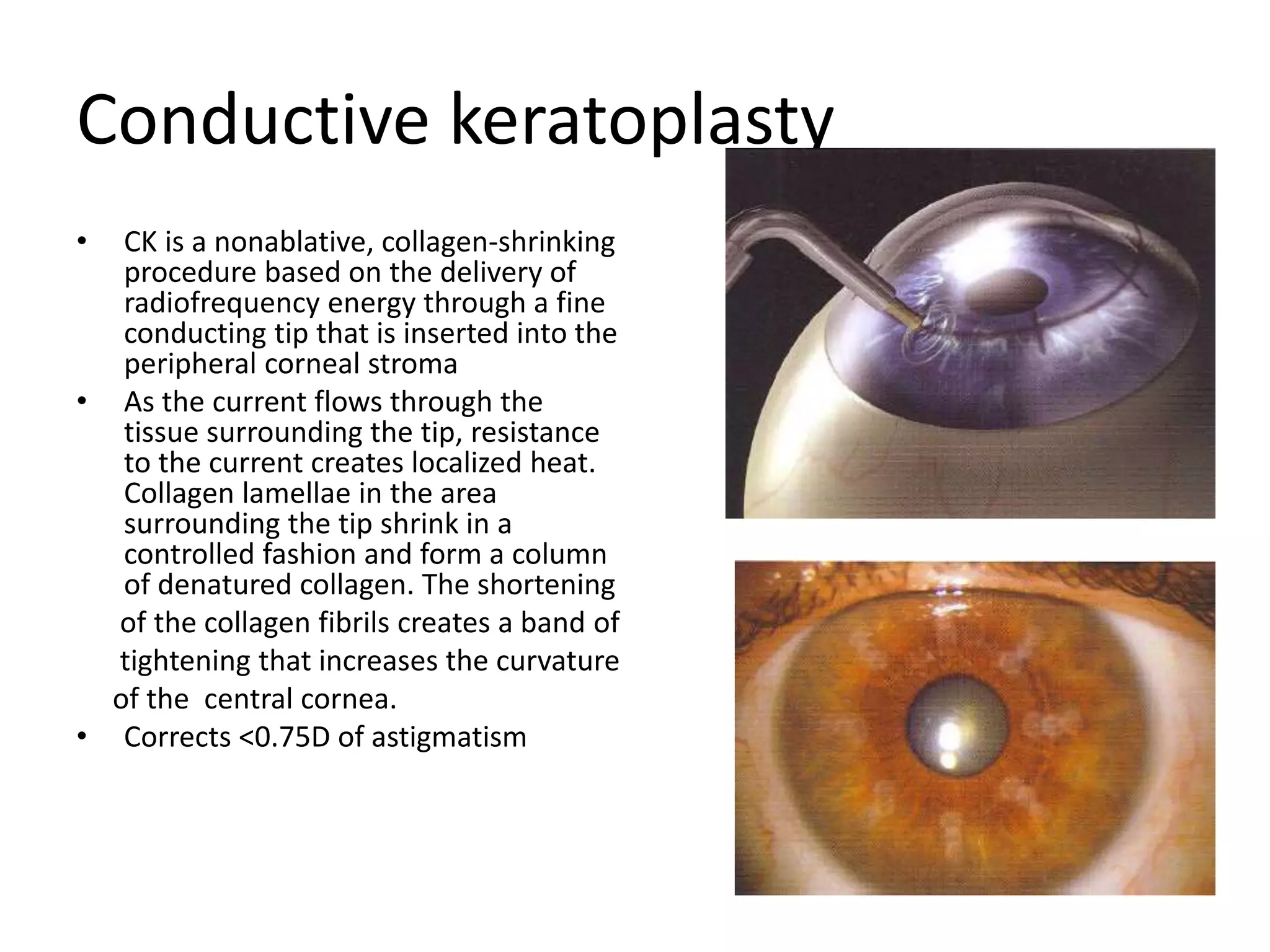 Conductive keratoplasty
• CK is a nonablative, collagen-shrinking
procedure based on the delivery of
radiofrequency energy through a fine
conducting tip that is inserted into the
peripheral corneal stroma
• As the current flows through the
tissue surrounding the tip, resistance
to the current creates localized heat.
Collagen lamellae in the area
surrounding the tip shrink in a
controlled fashion and form a column
of denatured collagen. The shortening
of the collagen fibrils creates a band of
tightening that increases the curvature
of the central cornea.
• Corrects <0.75D of astigmatism
 