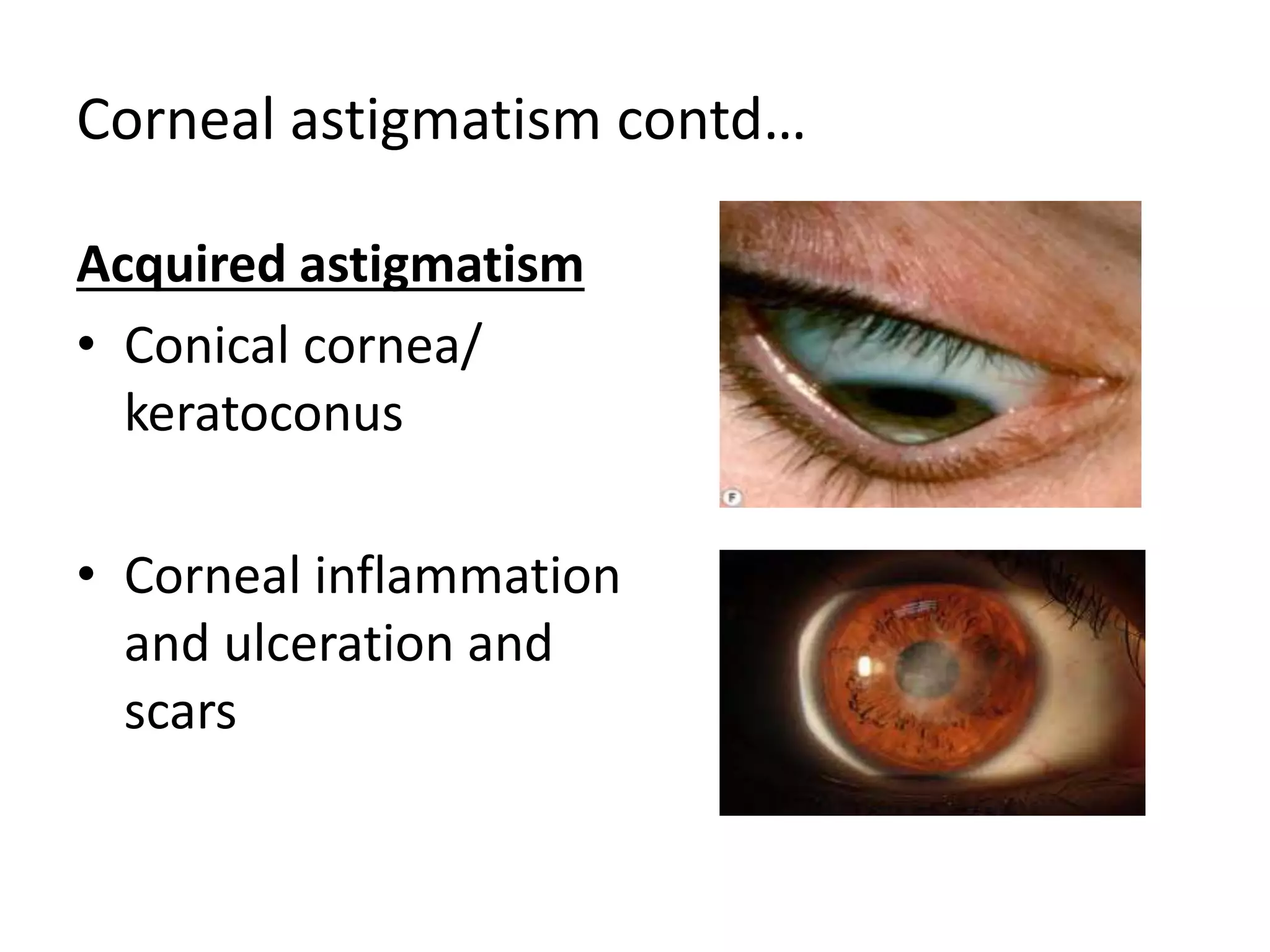 Corneal astigmatism contd…
Acquired astigmatism
• Conical cornea/
keratoconus
• Corneal inflammation
and ulceration and
scars
 