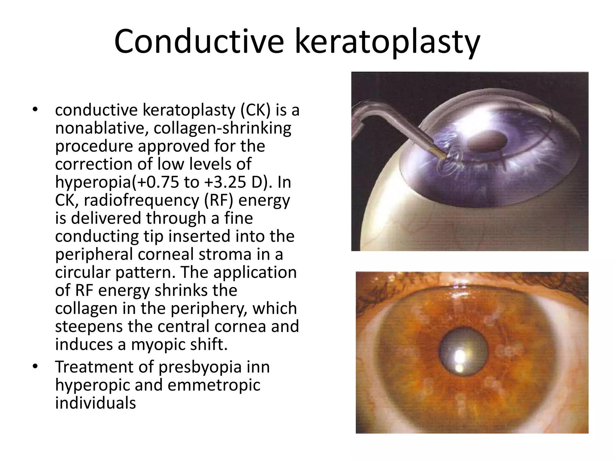 Conductive keratoplasty
• conductive keratoplasty (CK) is a
nonablative, collagen-shrinking
procedure approved for the
correction of low levels of
hyperopia(+0.75 to +3.25 D). In
CK, radiofrequency (RF) energy
is delivered through a fine
conducting tip inserted into the
peripheral corneal stroma in a
circular pattern. The application
of RF energy shrinks the
collagen in the periphery, which
steepens the central cornea and
induces a myopic shift.
• Treatment of presbyopia inn
hyperopic and emmetropic
individuals
 