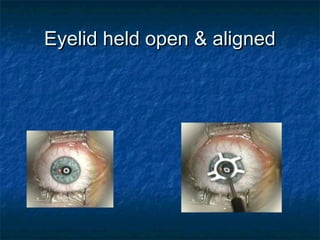 Eyelid held open & alignedEyelid held open & aligned
 