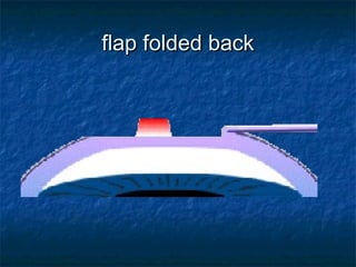 flap folded backflap folded back
 