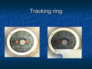 Tracking ringTracking ring
 
