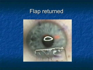 Flap returnedFlap returned
 