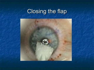 Closing the flapClosing the flap
 