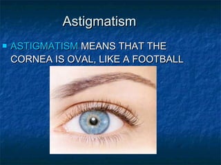 AstigmatismAstigmatism
 ASTIGMATISMASTIGMATISM MEANS THAT THEMEANS THAT THE
CORNEA IS OVAL, LIKE A FOOTBALLCORNEA IS OVAL, LIKE A FOOTBALL
 