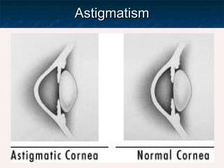 AstigmatismAstigmatism
 