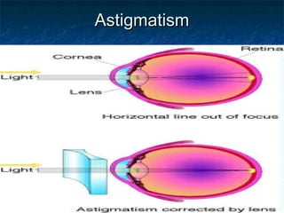 AstigmatismAstigmatism
 