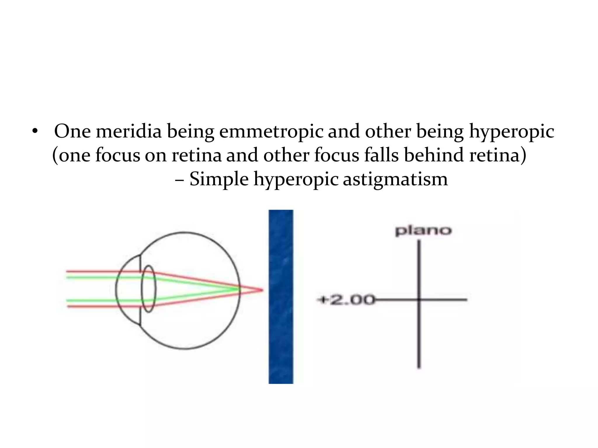 Astigmatism | PPTX