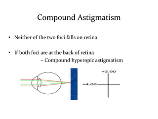 Astigmatism | PPTX