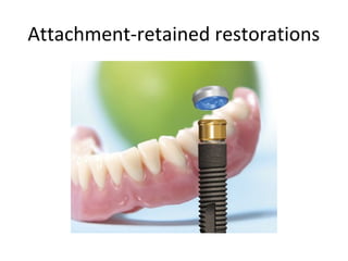 Attachment-retained restorations
 
