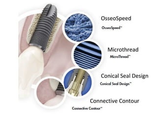 OsseoSpeed
Microthread
Conical Seal Design
Connective Contour
 