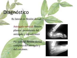 Diagnóstico Rx lateral en flexión dorsal:  Astrágalo vertical:  flexión  plantar  persistente del  astrágalo y del calcáneo  Pie normal: flexión dorsal  completa del astrágalo y  del calcáneo.  